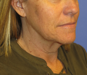 FACEology Lift / Neck Lift Case 5604 Before Photo FACEology Lift / Neck Lift
