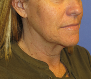 FACEology Lift / Neck Lift