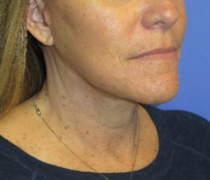 FACEology Lift / Neck Lift Case 5604 After Photo FACEology Lift / Neck Lift