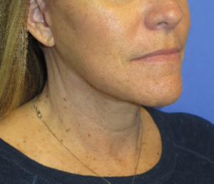 FACEology Lift / Neck Lift