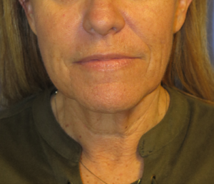 FACEology Lift / Neck Lift Case 5604 Before Photo FACEology Lift / Neck Lift