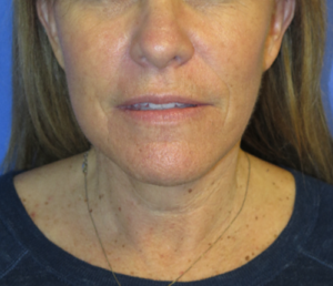 FACEology Lift / Neck Lift Case 5604 After Photo FACEology Lift / Neck Lift