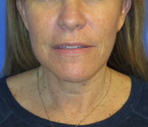 FACEology Lift / Neck Lift