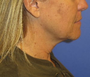 FACEology Lift / Neck Lift Case 5604 Before Photo FACEology Lift / Neck Lift