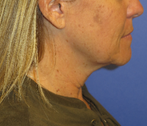 FACEology Lift / Neck Lift