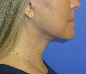 FACEology Lift / Neck Lift Case 5604 After Photo FACEology Lift / Neck Lift
