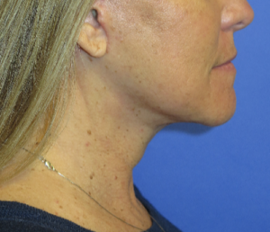 FACEology Lift / Neck Lift