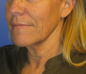 FACEology Lift / Neck Lift Case 5604 Before Photo FACEology Lift / Neck Lift
