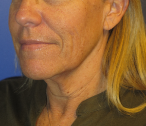 FACEology Lift / Neck Lift