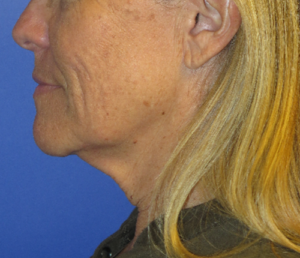 FACEology Lift / Neck Lift Case 5604 Before Photo FACEology Lift / Neck Lift