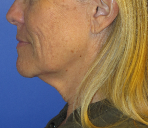 FACEology Lift / Neck Lift