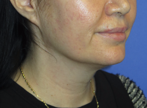 FACEology Lift / Neck Lift Case 5799 Before Photo FACEology Lift / Neck Lift