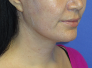 FACEology Lift / Neck Lift Case 5799 After Photo FACEology Lift / Neck Lift