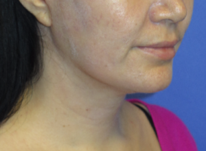 FACEology Lift / Neck Lift