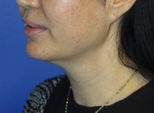 FACEology Lift / Neck Lift Case 5799 Before Photo FACEology Lift / Neck Lift
