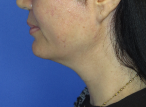 FACEology Lift / Neck Lift Case 5799 Before Photo FACEology Lift / Neck Lift