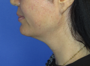 FACEology Lift / Neck Lift