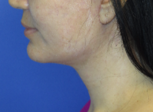 FACEology Lift / Neck Lift Case 5799 After Photo FACEology Lift / Neck Lift