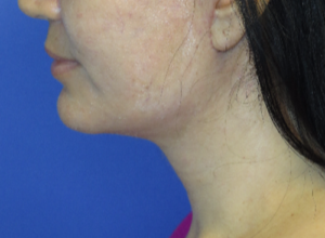 FACEology Lift / Neck Lift