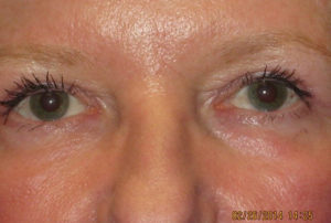 Eyelid Lift Case 5545 After Photo Eyelid Lift