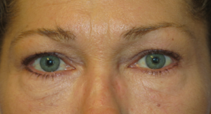 Eyelid Lift