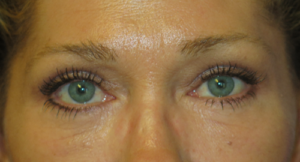 Eyelid Lift