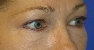 Eyelid Lift