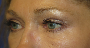 Eyelid Lift