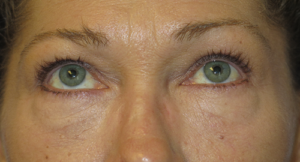 Eyelid Lift