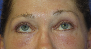 Eyelid Lift