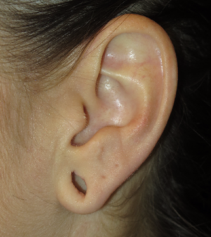 Ear Surgery Case 5382 Before Photo Ear Surgery