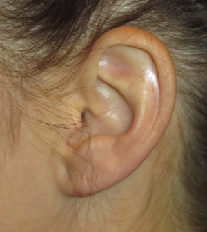 Ear Surgery Case 5382 After Photo Ear Surgery