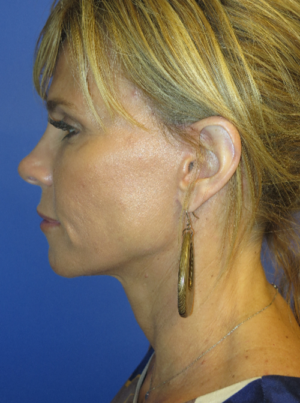 FACEology Lift / Neck Lift Case 5725 After Photo FACEology Lift / Neck Lift