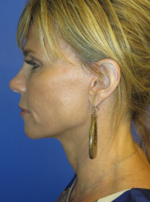 FACEology Lift / Neck Lift