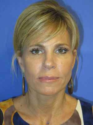 FACEology Lift / Neck Lift