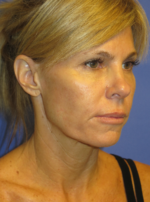 FACEology Lift / Neck Lift