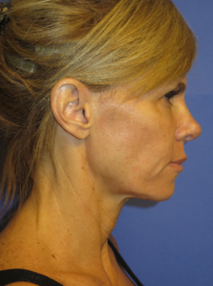 FACEology Lift / Neck Lift Case 5725 Before Photo FACEology Lift / Neck Lift