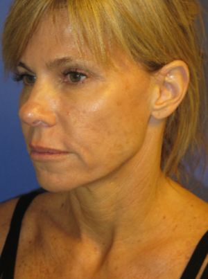 FACEology Lift / Neck Lift Case 5725 Before Photo FACEology Lift / Neck Lift
