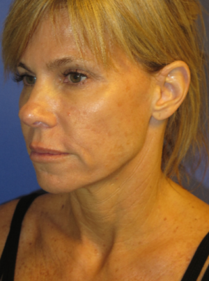 FACEology Lift / Neck Lift