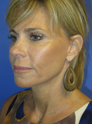 FACEology Lift / Neck Lift Case 5725 After Photo FACEology Lift / Neck Lift