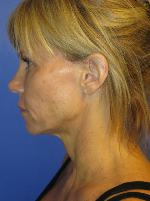 FACEology Lift / Neck Lift Case 5725 Before Photo FACEology Lift / Neck Lift