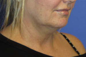 FACEology Lift / Neck Lift