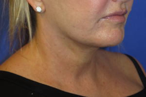 FACEology Lift / Neck Lift