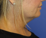 FACEology Lift / Neck Lift