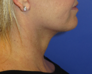 FACEology Lift / Neck Lift