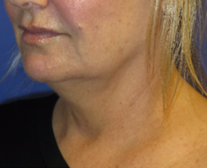 FACEology Lift / Neck Lift