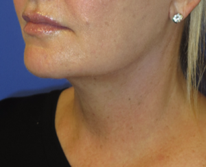 FACEology Lift / Neck Lift