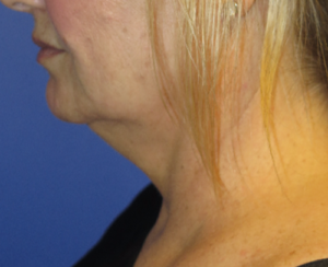 FACEology Lift / Neck Lift