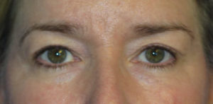 Eyelid Lift Case 5551 Before Photo Eyelid Lift