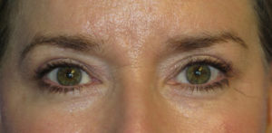 Eyelid Lift Case 5551 After Photo Eyelid Lift